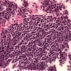 myelomaCB2